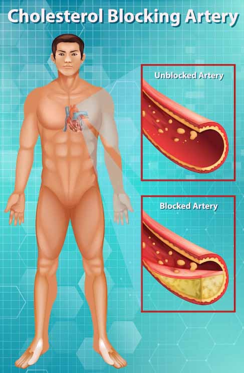 Artery Calcification Causes