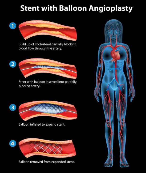 Balloon angioplasty and stenting