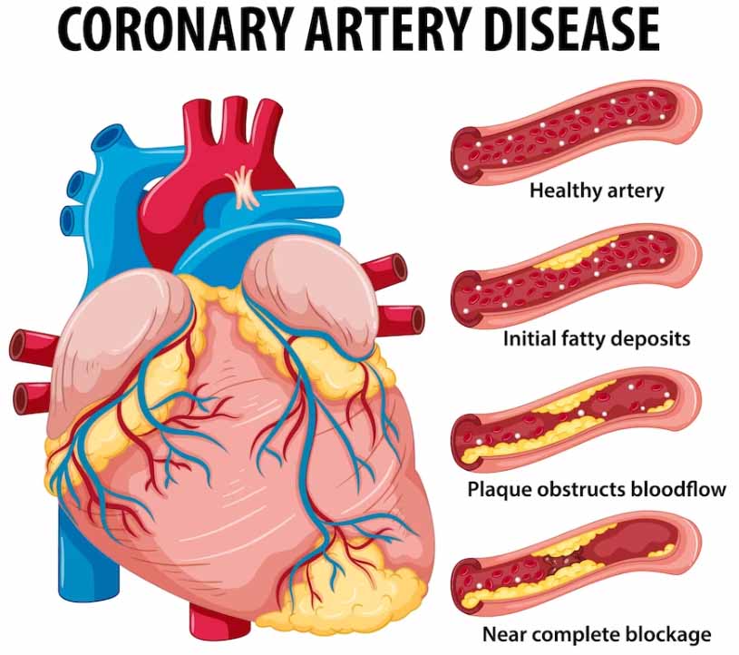 what is artery calcification coronary artery disease chart